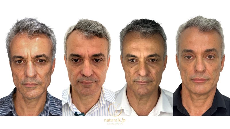 Caso clínico antes e depois 11