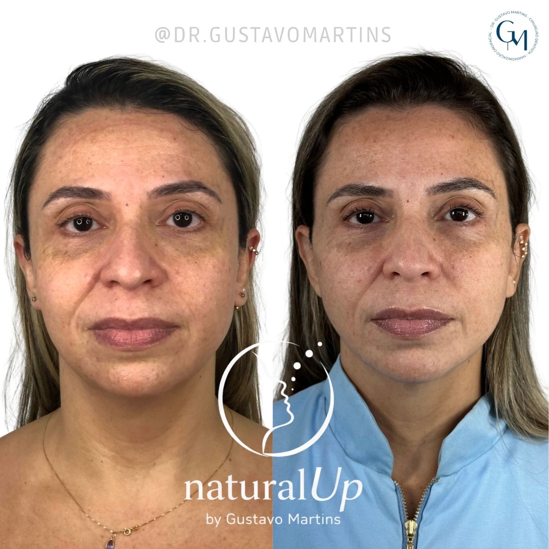 Caso clínico — antes e depois natural
